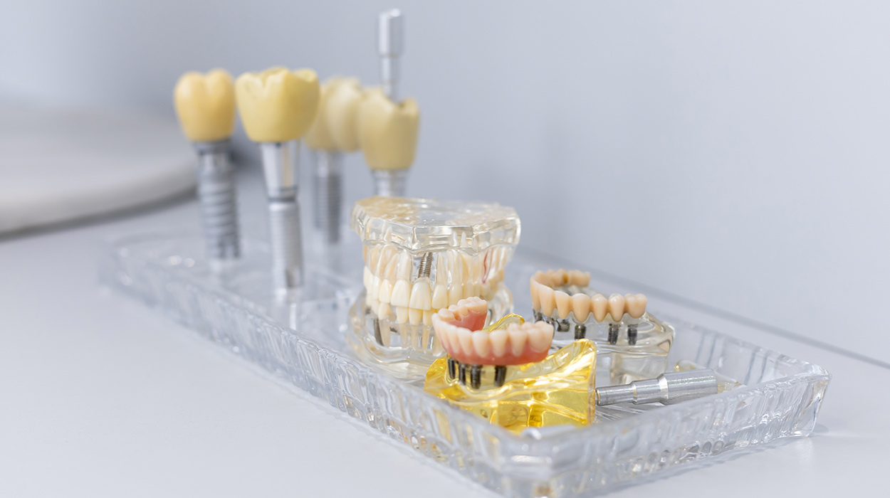 Featured image for “Quanto custa um implante dentário? Entenda o que está incluso no valor”