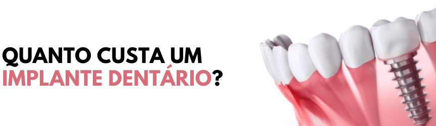 Featured image for “Quanto custa um implante?”