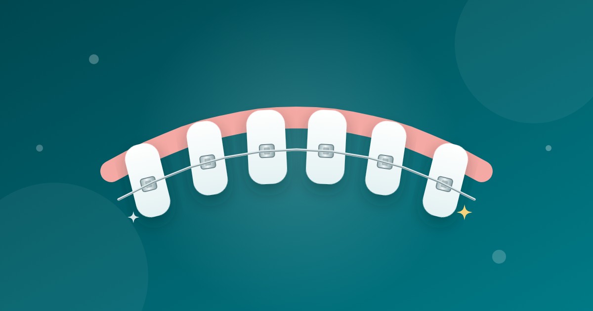 Featured image for “Quanto custa colocar aparelho nos dentes?”
