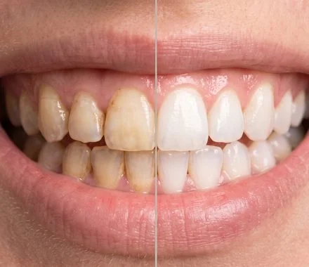 Antes e depois de clareamento dental mostrando dentes amarelados e brancos – Indaiatuba