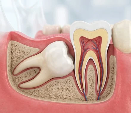 Ilustração de dente siso incluso pressionando o dente vizinho – extração de siso em Indaiatuba