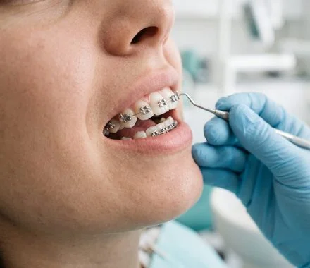 Paciente com aparelho ortodôntico fixo durante consulta – ortodontia em Indaiatuba