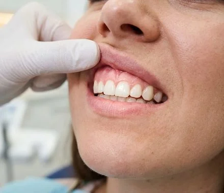 Dentista avaliando a gengiva da paciente – tratamento periodontal em Indaiatuba