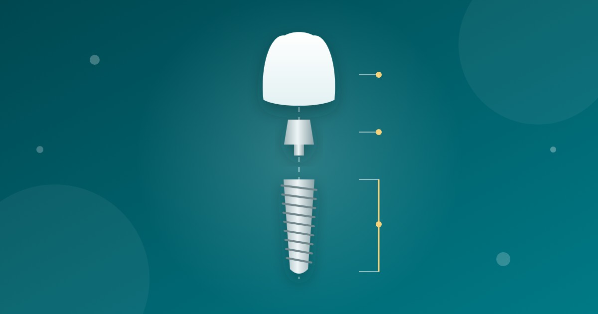 Featured image for “Pino de implante dentário: preço e o que está incluso”