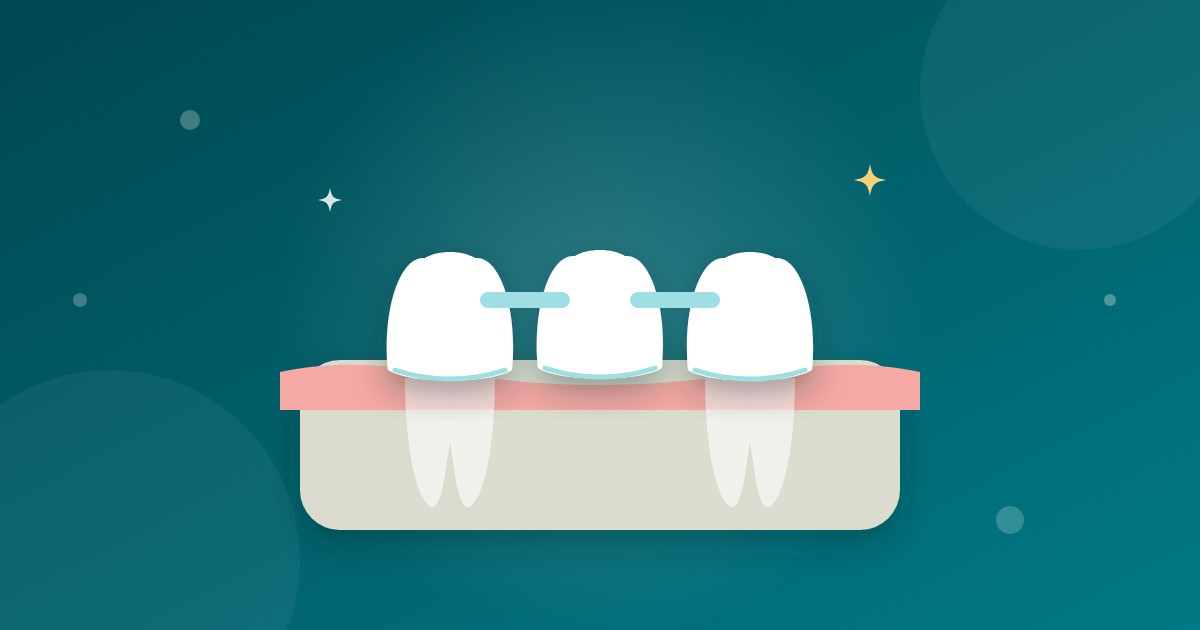 Featured image for “Prótese fixa sem implante: valor e diferenças em relação ao implante”