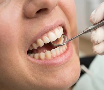 Dentista examinando os dentes da paciente com espelho clínico – reabilitação oral em Indaiatuba